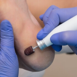 Лечение ногтей:Коррекция вросших ногтей, Терапия грибковых заболеваний